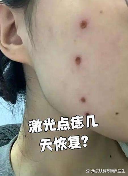 激光点痣大概多久恢复正常