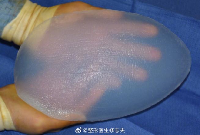 硅胶假体 硅胶假体
