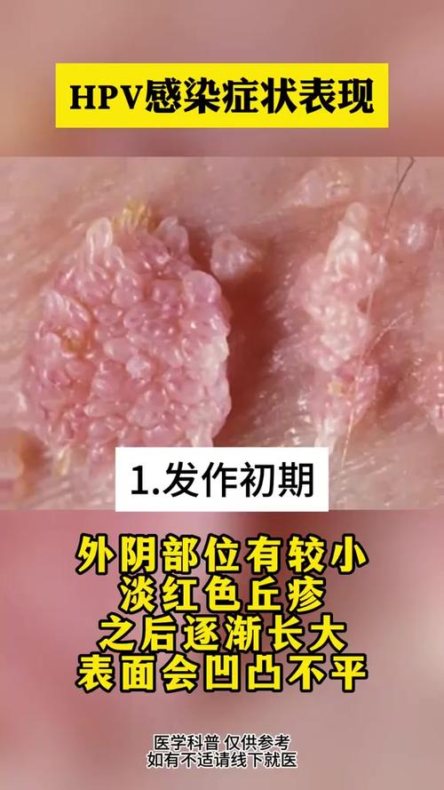 女性得了hpv是什么症状