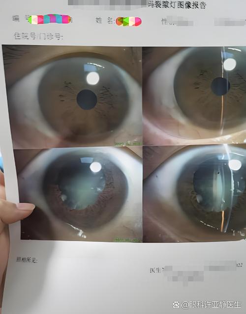 双眼看东西重影怎么回事