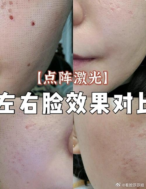 激光点阵修复疤痕多少钱