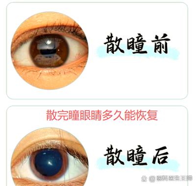 散完瞳眼睛多久能恢复