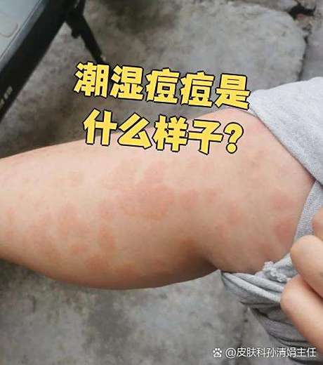 湿毒起疙瘩图片
