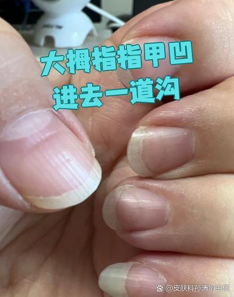 右手大拇指指甲凹陷