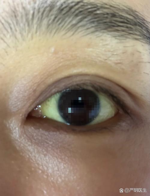 眼白什么颜色最健康