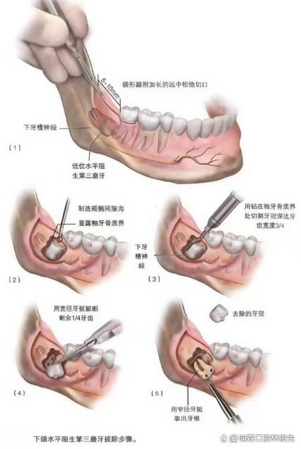 直接拔除智齿截图2