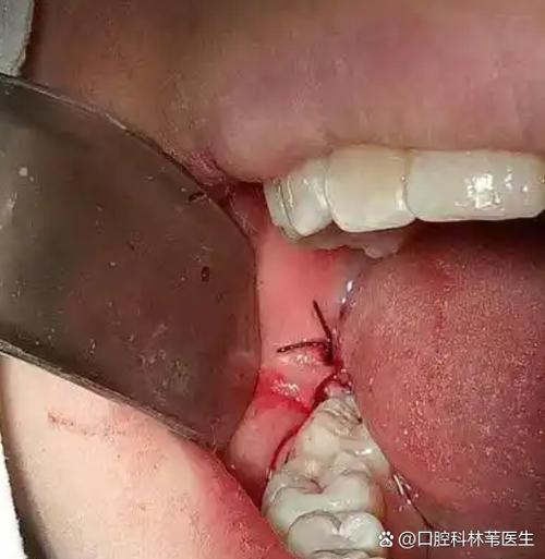 直接拔除智齿截图3