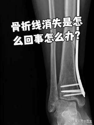 人的骨头多久会彻底消失截图1