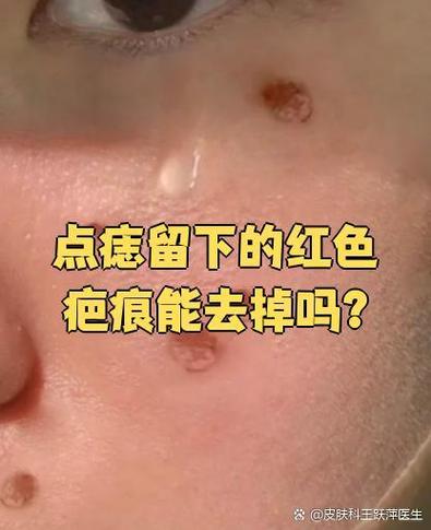 点痣落的疤可以去掉吗