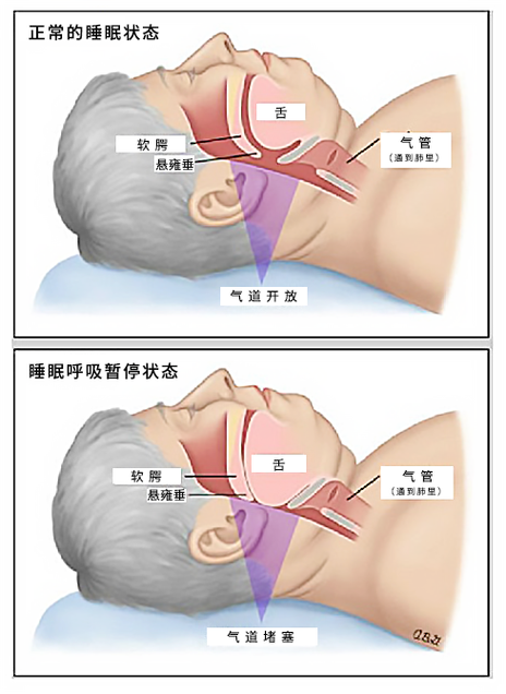睡眠呼吸暂停综合征能治愈吗