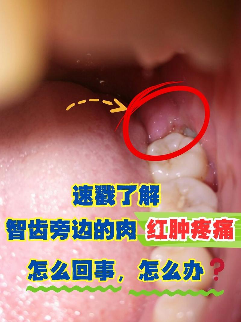 为啥拔智齿的都后悔