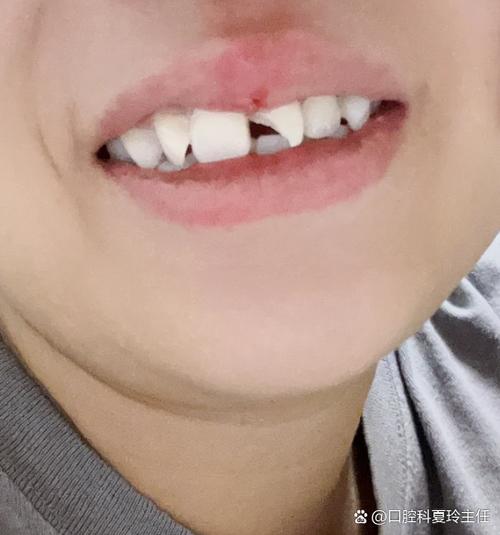 9岁小孩牙齿磕掉一小块