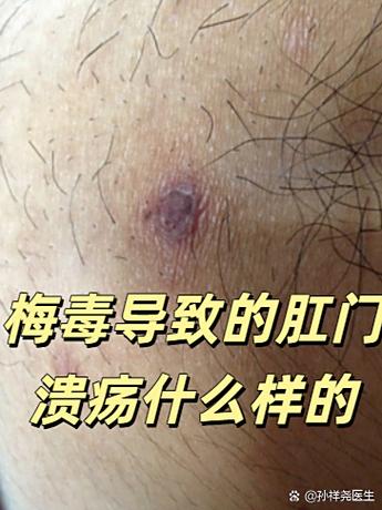 溃疡是什么原因引起的截图2