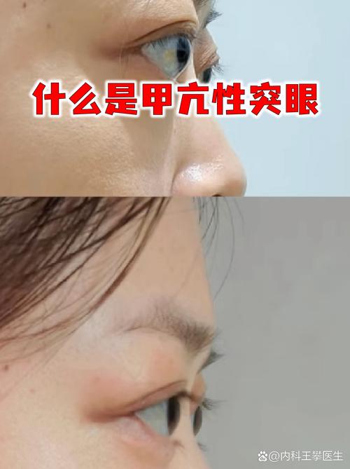 甲亢一定会凸眼吗