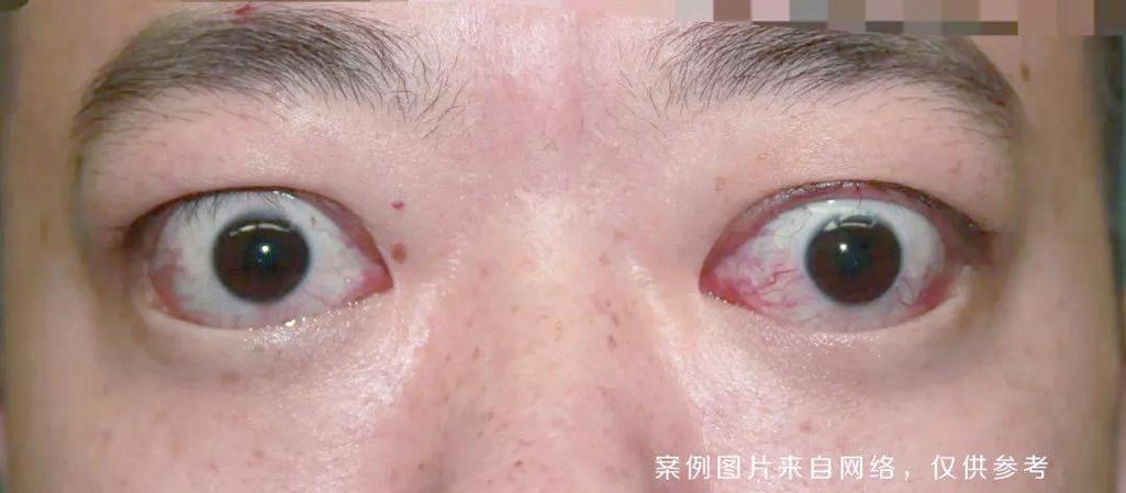 甲亢一定会凸眼吗截图2