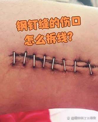 伤口缝线自己可以拆吗