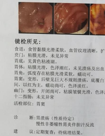胃溃疡是怎么引起的