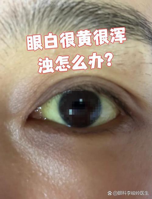 眼白发黄是什么原因