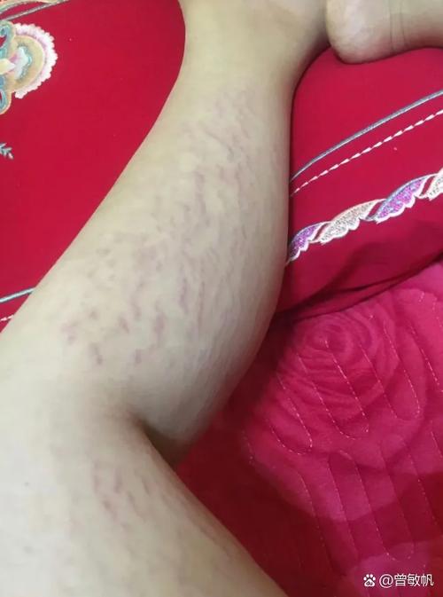 身体出现红色条纹是什么症状