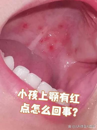 儿童口腔溃疡怎么引起的原因图片