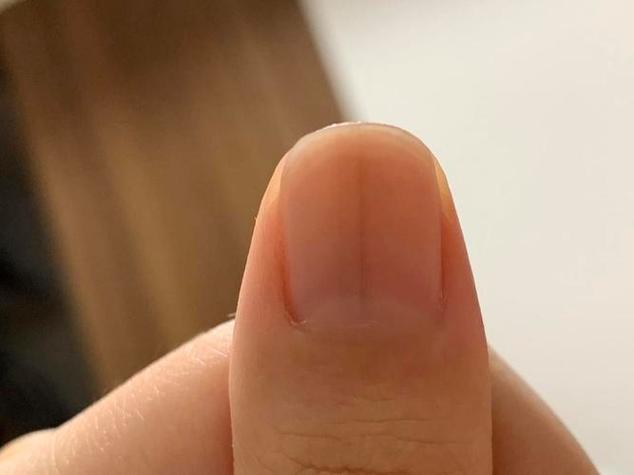 大拇指指甲有棕色竖纹