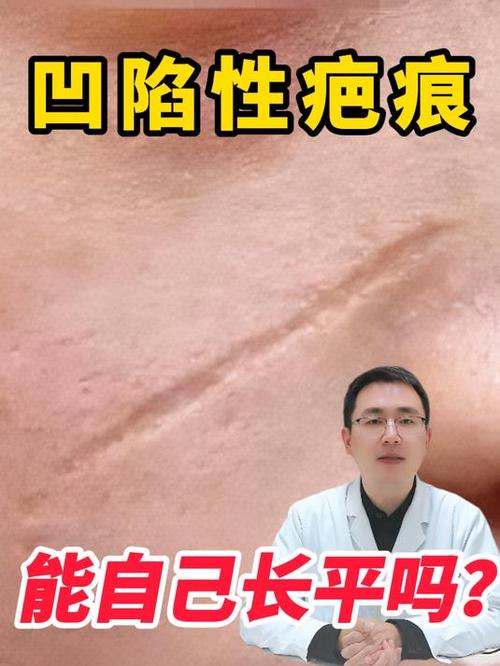 凹陷疤痕做激光几次能长平