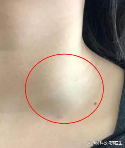 脖子上有溜是癌症吗