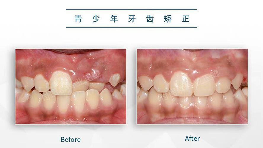 矫正错误还是校正错误