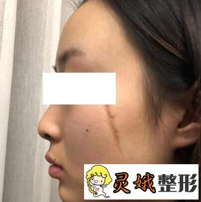 点阵激光去疤痕3次对比