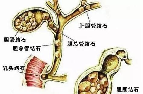 肾结石吃青柠檬还是黄柠檬