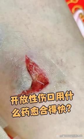 划伤了用什么药好得快