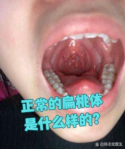 正常人扁桃体图片