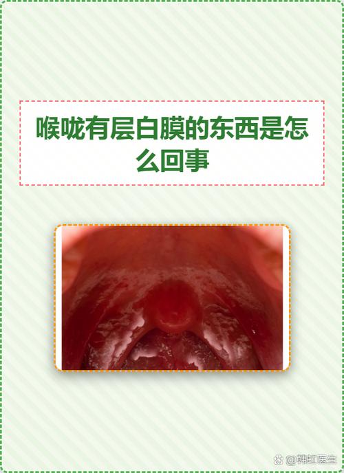 为什么经常口腔溃疡是怎么引起的
