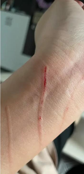 被猫抓了一下轻微破皮