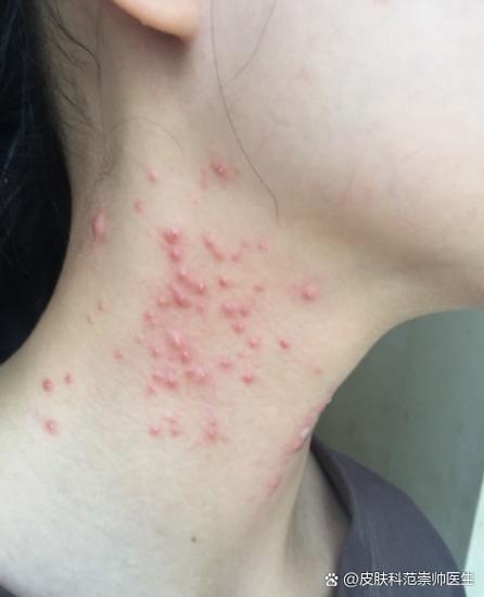 皮肤长痘痘去医院挂什么科