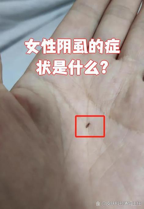 阴虱子是怎么长出来的
