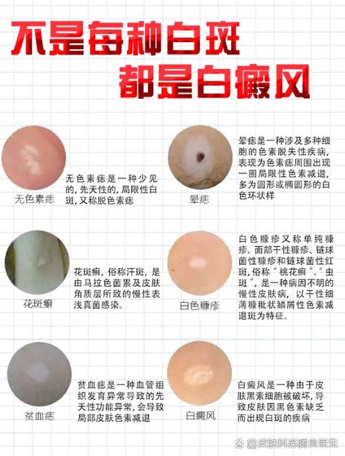 身上出现白色斑块是什么原因