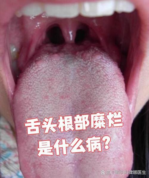 口腔溃疡是什么原因造成的