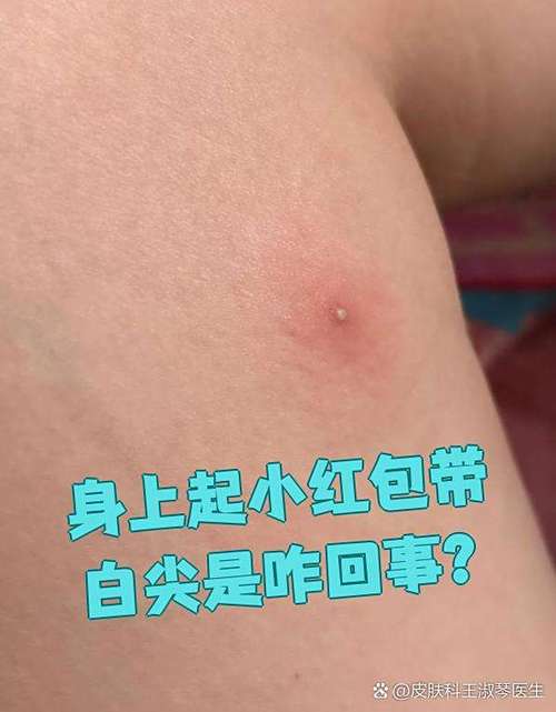 身上起了一个小红包