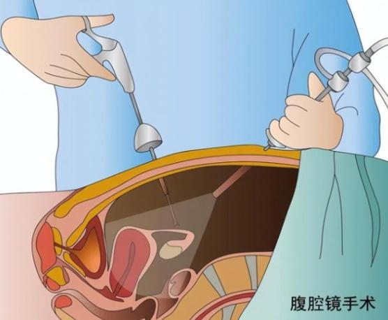 宫腹腔镜联合是大手术吗 宫腹腔镜联合是大手术吗