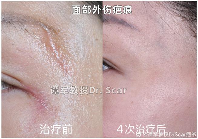 点阵激光对凹陷疤痕有用吗截图3