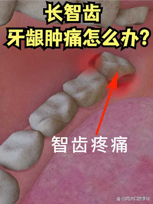 智齿拔除后的注意事项