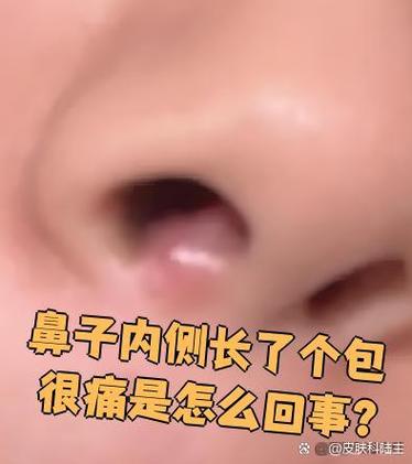 鼻子里长了一个包一碰就疼