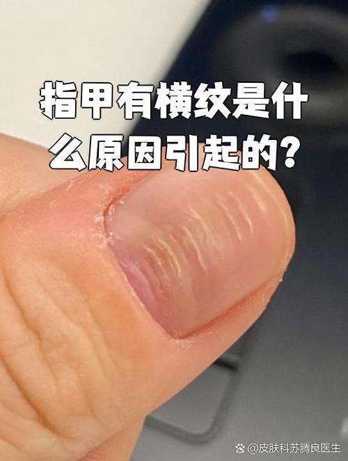 大拇指指甲上有横纹是怎么回事