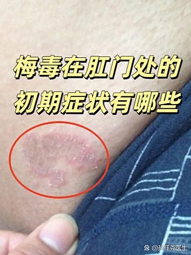 梅毒咨询医生免费咨询