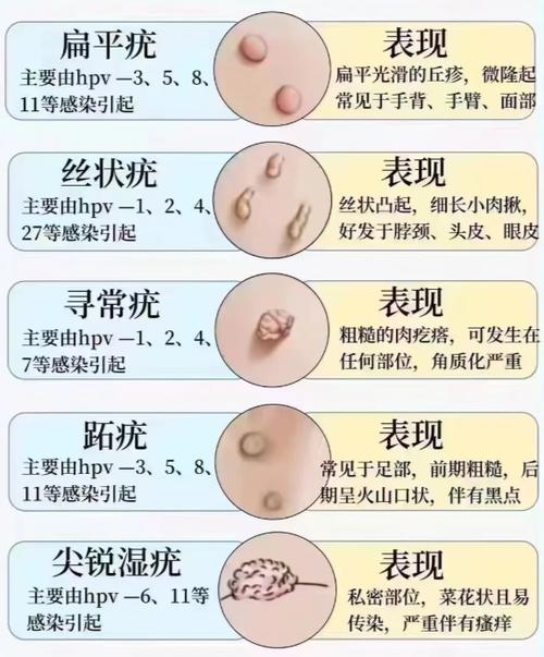 小肉揪揪是什么疣