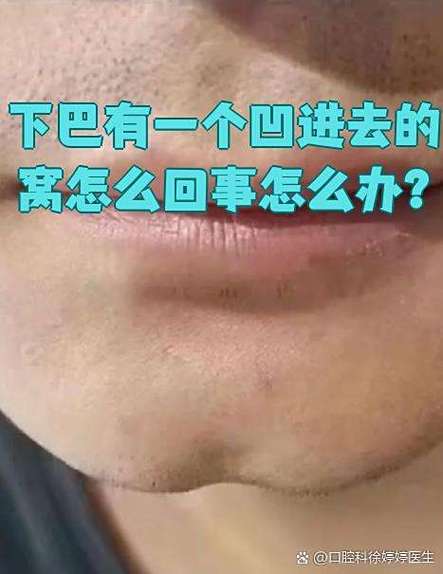 下巴有一个凹进去的窝