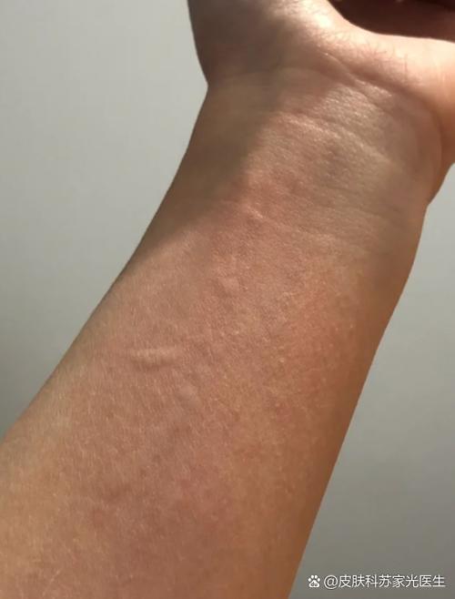 手和胳膊痒,一挠就起疙瘩