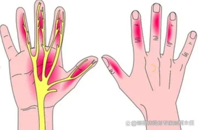 手经常发麻怎么办