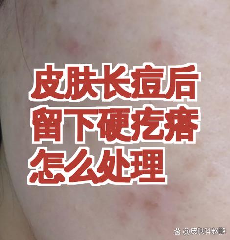 挤了痘痘后留下了一个硬块怎么办